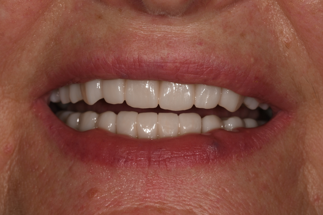 Patient: Woman, 53 years old, Full Mouth Restoration